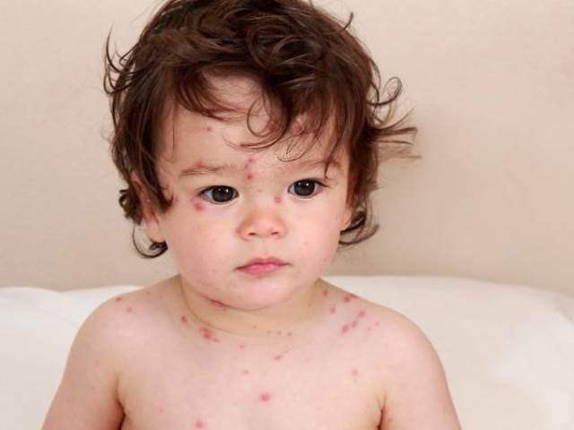 Mùa dịch bệnh thủy đậu ở trẻ em: Chi tiết cách điều trị và những kiêng kỵ
