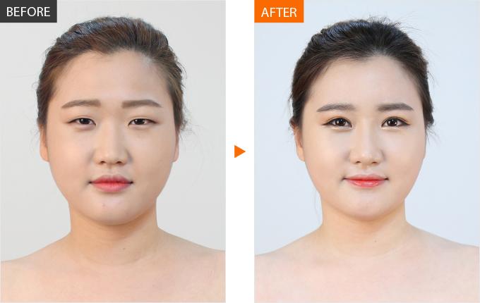 Giải đáp thắc mắc của hàng ngàn chị em với câu hỏi:amp;#34;Cắt mí mắt có hại không?amp;#34; - 1