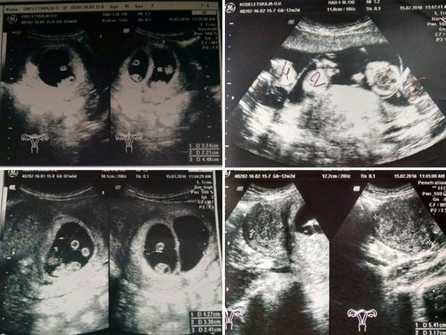 Hình ảnh siêu âm thai khiến bác sĩ tròn mắt ngạc nhiên, mẹ bầu tim ngừng đập vì lo lắng