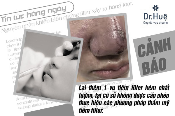 Bác sĩ tư vấn: Những biến chứng và hậu quả của việc tiêm Filler