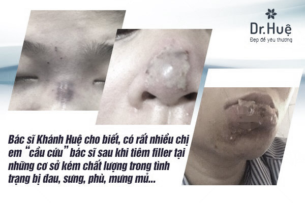 Bác sĩ tư vấn: Những biến chứng và hậu quả của việc tiêm Filler