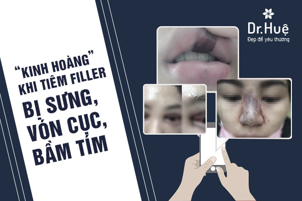 Tiêm filler bị vón cục, sưng đau, bầm tím - vì đâu nên nỗi?