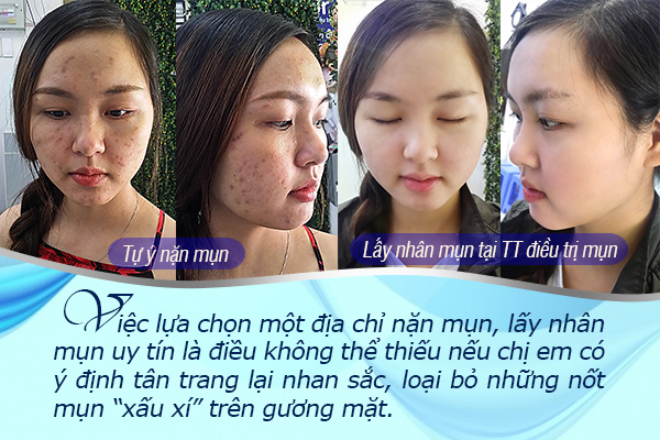 Điều trị mụn Dr. Huệ: Địa chỉ lấy nhân mụn, nặn mụn uy tín ở Gò Vấp TP.HCM