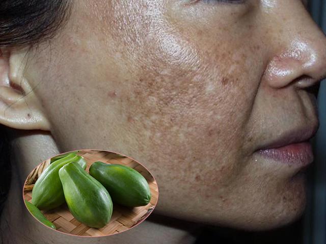 Nám nặng cỡ nào cũng biến mất nhờ 2 cách dễ ợt từ đu đủ xanh