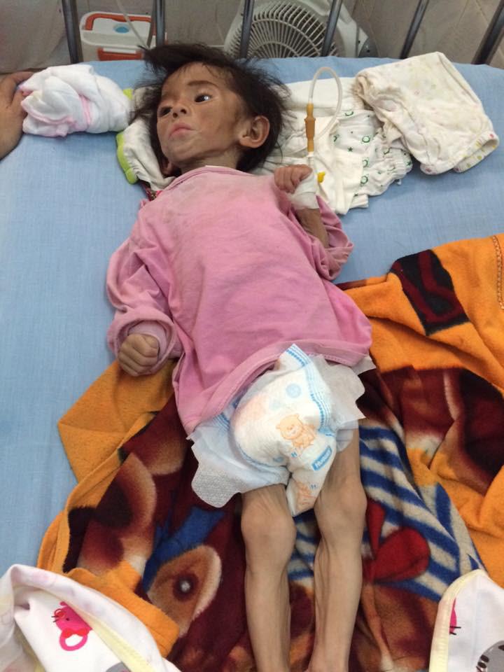 Hình ảnh mới nhất của bé gái Lào Cai bị suy dinh dưỡng: Cằm nhọn ...