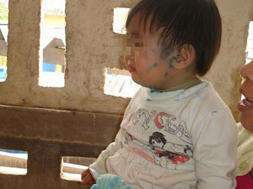 Bệnh thủy đậu ở trẻ em: Triệu chứng và cách chăm sóc