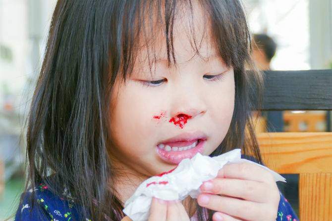 Trẻ bị chảy máu cam: Không ngả đầu ra sau, bằng không sẽ nguy hiểm