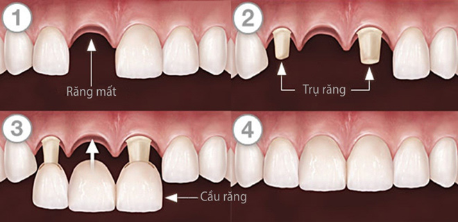 Lý giải vì sao trồng răng sứ 1 răng phải làm thành 3 răng