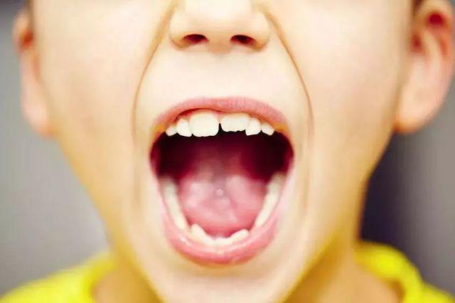 Uống loại nước này mỗi ngày khiến hàm răng của cậu bé 2 tuổi bị hư hại nghiêm trọng
