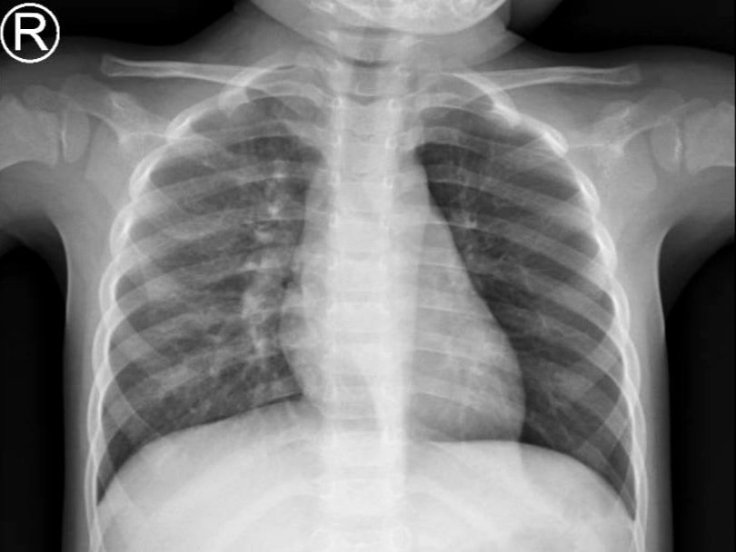 Bé gái 3 tuổi bị hóc đậu phộng nhưng chẩn đoán nhầm là viêm phổi - 1