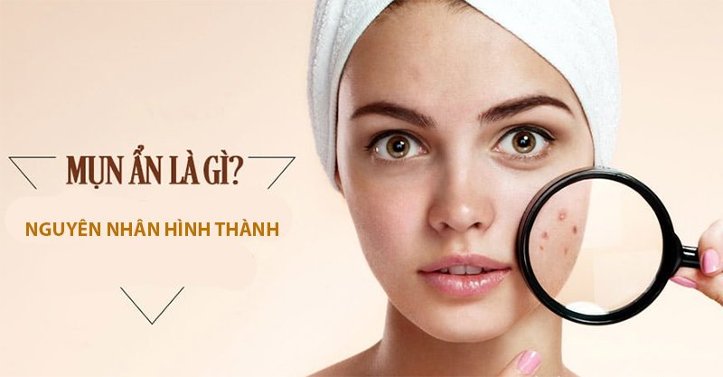 15 cach tri mun an tai nha bang thien nhien an toan hieu qua nhat - 1