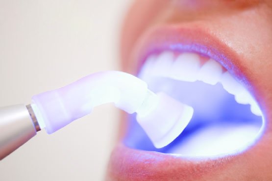 Tẩy trắng răng có hại gì với sức khỏe và có đau không? - 5