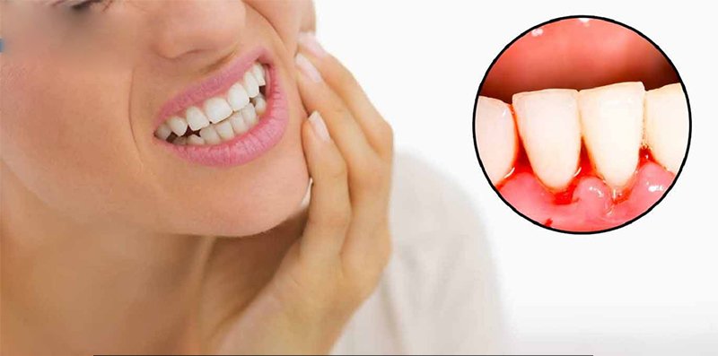 Tẩy trắng răng có hại gì với sức khỏe và có đau không? - 7