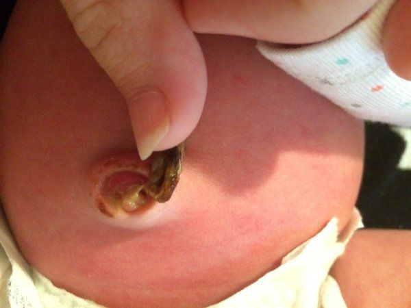 Hình ảnh rốn trẻ sơ sinh bị nhiễm trùng khiến nhiều mẹ sửng sốt