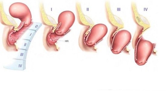 Hình ảnh sa tử cung độ 2 ở phụ nữ bị sa tử cung sau sinh