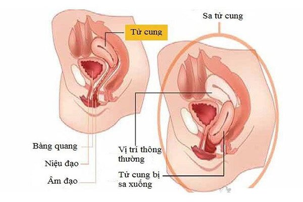 Hình ảnh sa tử cung độ 2 ở phụ nữ bị sa tử cung sau sinh