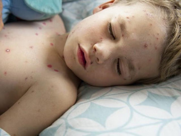 Bệnh thủy đậu ở trẻ em nên kiêng gì và cách điều trị tại nhà nhanh khỏi