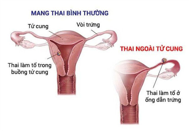dau hieu mang thai ngoai tu cung thang dau som nhat, tranh nham lan - 1