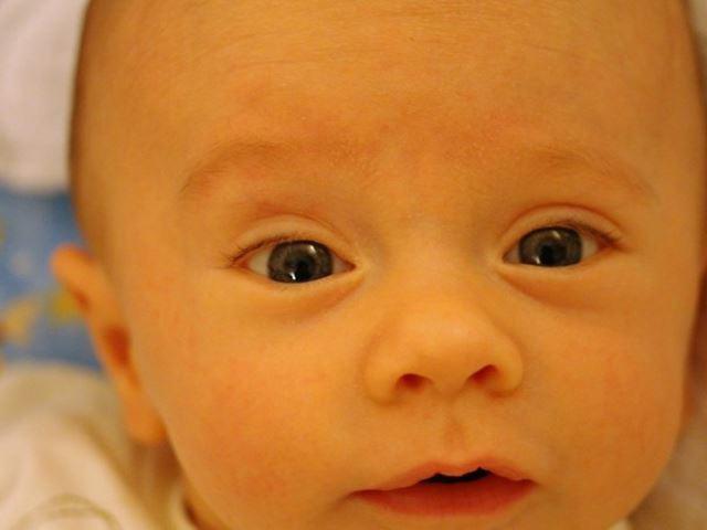 Trẻ sơ sinh bị vàng da vàng mắt như thế nào là nguy hiểm? - 1