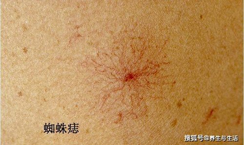 noi khong voi bia ruou nhung lai mac ung thu gan, 2 thoi quen nay chinh la thu pham - 5