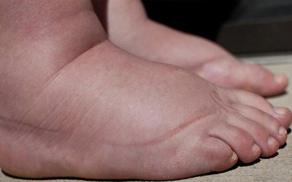 Viêm cầu thận nguyên nhân do đâu và dấu hiệu nhận biết - 4