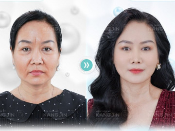 Có phản ứng phụ nào thường gặp liên quan đến việc sử dụng Max Collagen Siêu Vi Điểm không?
