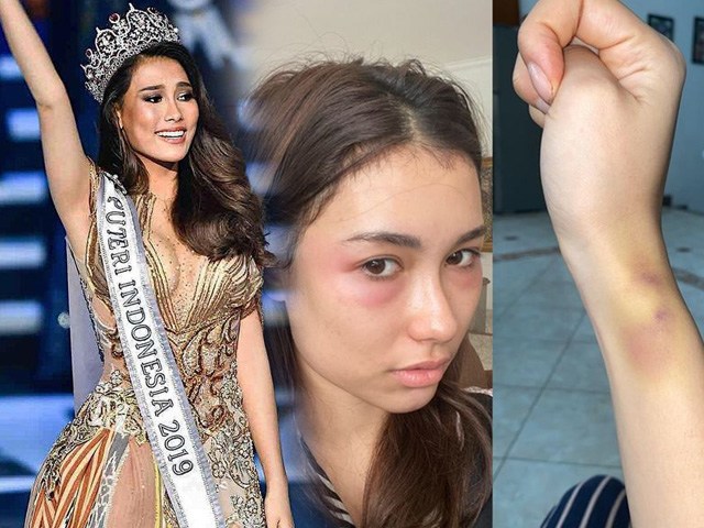 Hoa hậu Indonesia hỏng mặt vì phẫu thuật thẩm mỹ, chuyên gia nói gì về trường hợp này?