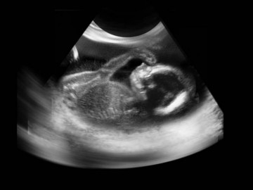 Siêu âm 3D và 4D có thể giúp nhìn thấy khuôn mặt em bé trong tử cung không?
