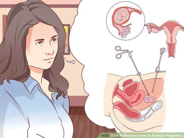 Cách điều trị thai ngoài tử cung để đảm bảo lần sau không tái phát