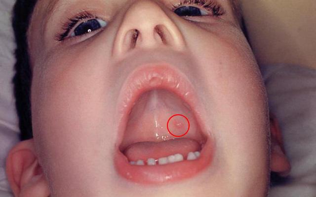 Hình ảnh bệnh thủy đậu ở trẻ em, cha mẹ cần biết để điều trị hiệu ...