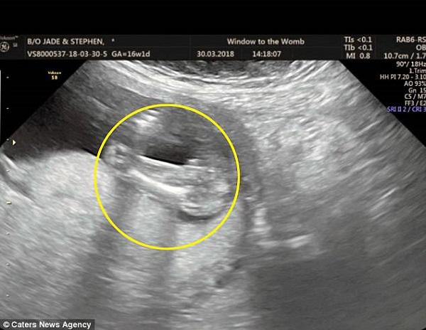 Hãy nhìn vào hình ảnh siêu âm thai giống để nhận biết được sự phát triển của bé yêu trong bụng mẹ. Với siêu âm thai giống, bạn có thể biết được giới tính của bé và tìm hiểu nhiều hơn về sức khỏe của bé trước khi ra đời.