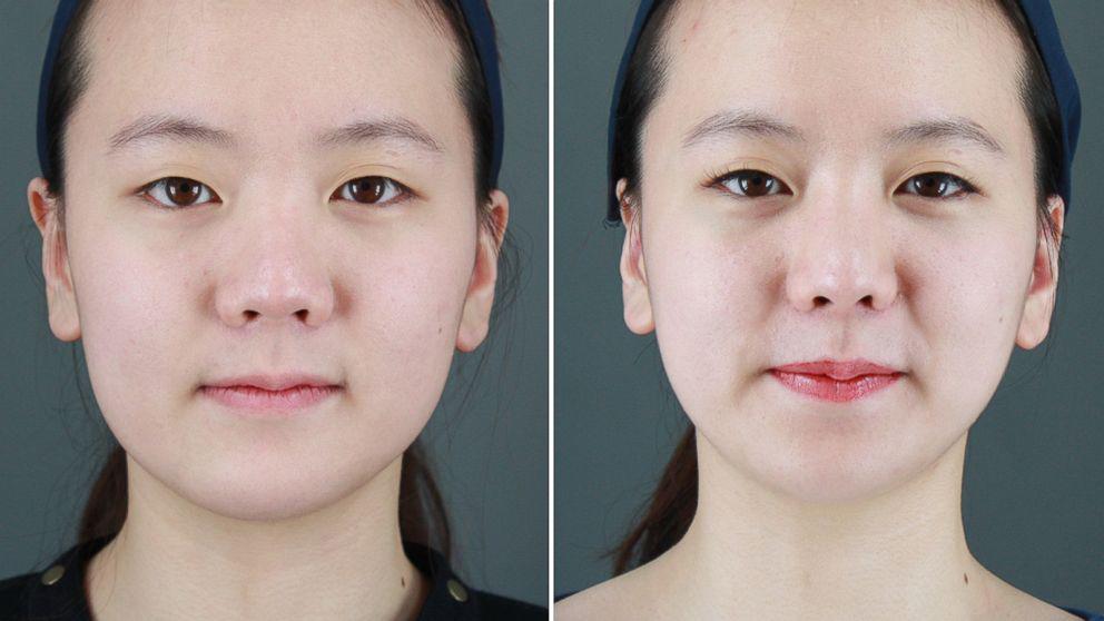 Có nên phun môi Collagen không  Skincare Clinic JW Hàn Quốc