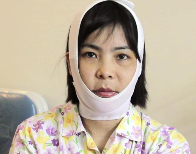 truot cam von phuc tap va co rui ro bien chung cao, vay chi em can luu y dieu gi? - 3