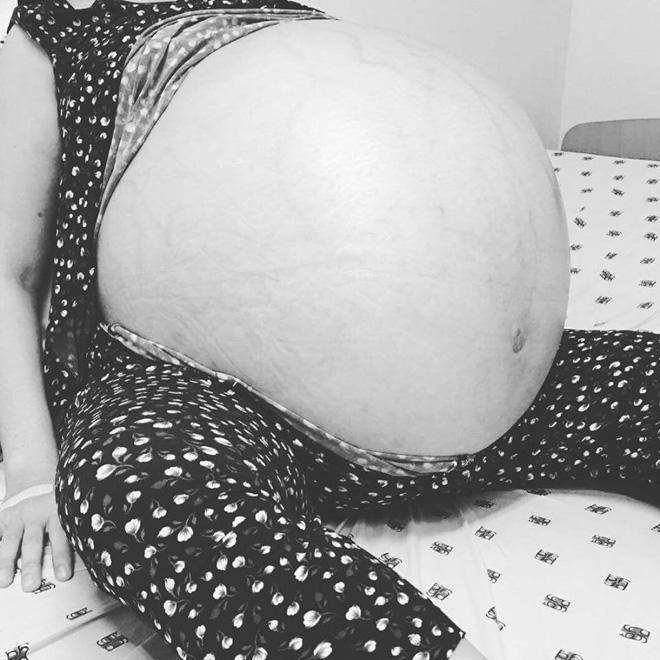 nguoi phu nu duoc giai thoat khoi khoi u “khung” nhat viet nam sau 4 nam mang trong bung - 1