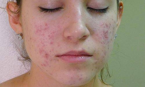 mat nhu vung com chay cung nhan min ngay voi 3 cach tri mun trung ca chua den 5 ngan - 1