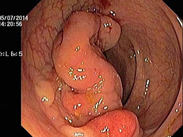 bac si ly giai vi sao nhieu nguoi trong mot nha cung bi ung thu dai truc trang - 2