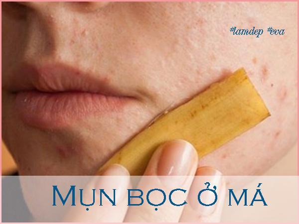 ngay nao cung lam theo, mun boc o ma nang co nao cung bi xoa mo cuc nhanh - 3