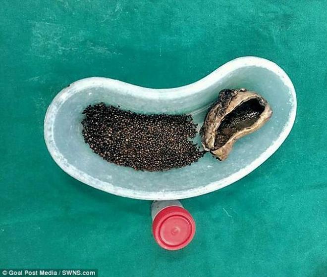 dau bung nhap vien, nguoi dan ong khien bac si kinh hai khi thay thu trong co the - 2