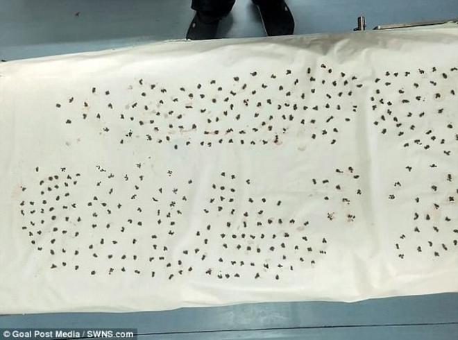 dau bung nhap vien, nguoi dan ong khien bac si kinh hai khi thay thu trong co the - 3