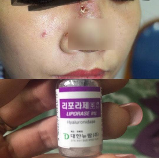 co gai 23 tuoi bi hoai tu mui sau tiem filler lam dep tai mot spa - 1