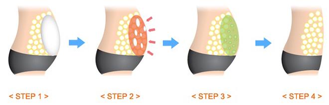 tiem tan mo: khong chay mau, khong phau thuat, hieu qua tinh bang thang, chi em da cap nhat chua? - 1