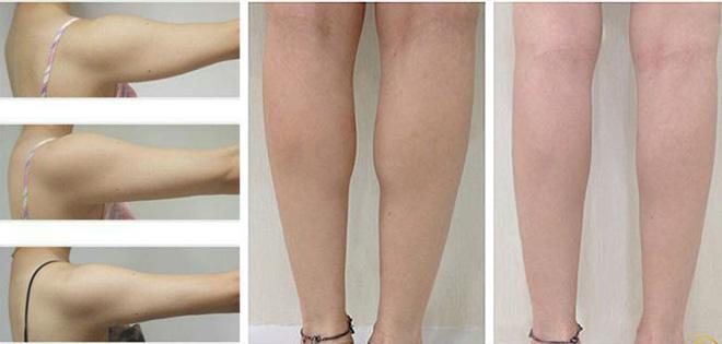 tiem tan mo: khong chay mau, khong phau thuat, hieu qua tinh bang thang, chi em da cap nhat chua? - 11