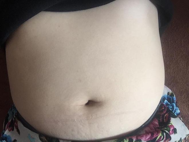 tiem tan mo: khong chay mau, khong phau thuat, hieu qua tinh bang thang, chi em da cap nhat chua? - 2