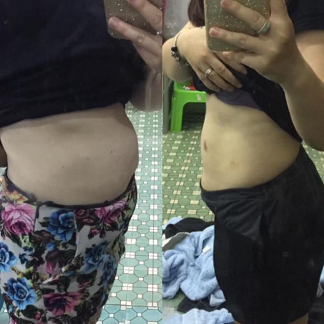 tiem tan mo: khong chay mau, khong phau thuat, hieu qua tinh bang thang, chi em da cap nhat chua? - 4