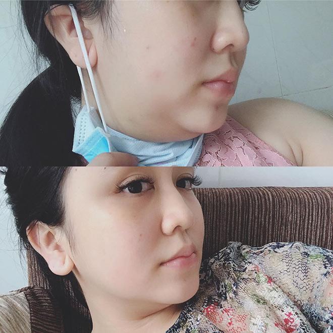 tiem tan mo: khong chay mau, khong phau thuat, hieu qua tinh bang thang, chi em da cap nhat chua? - 6