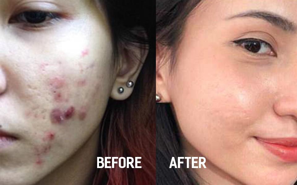 hanh trinh tri mun kien tri 11 nam cua co gai goc viet gay chan dong bao nuoc ngoai - 1