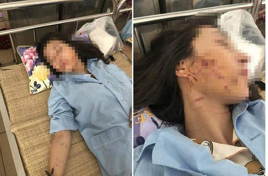 tin moi vu co gai tre bi do nuoc mam, muoi ot len nguoi: 3 phu nu bi khoi to - 2