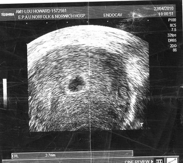 Siêu âm là phương pháp khám bệnh hiện đại nhưng không phải khi nào cũng thấy được thai. Hãy xem ngay những hình ảnh siêu âm không thấy thai để hiểu rõ hơn về những khó khăn mà phụ nữ có thể gặp phải trong thai kỳ.