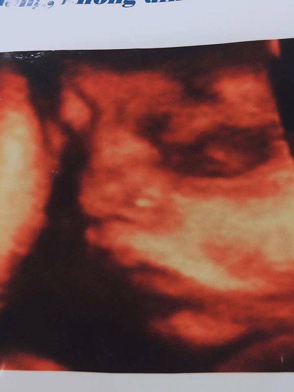 tin tuc 24h: xot xa be trai phai cat bo ruot vi hoai tu sau bua an dam dau tien - 2