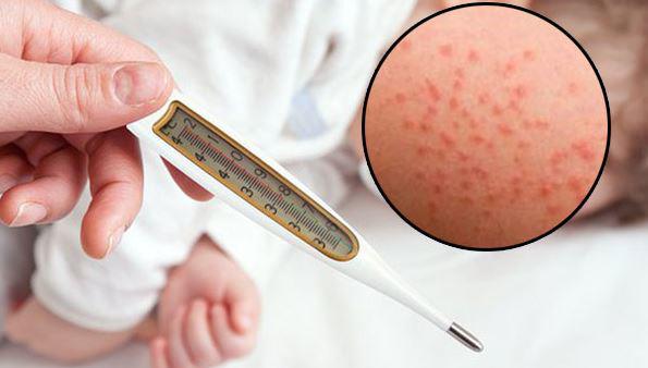 Sốt phát ban ở trẻ em: Nguyên nhân, dấu hiệu nhận biết và cách chăm sóc bé tại nhà - 3